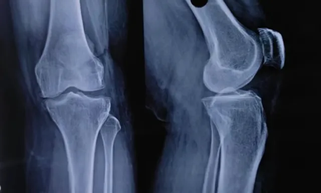 an x - ray of a knee showing the joint joint. Beautiful X-ray. 